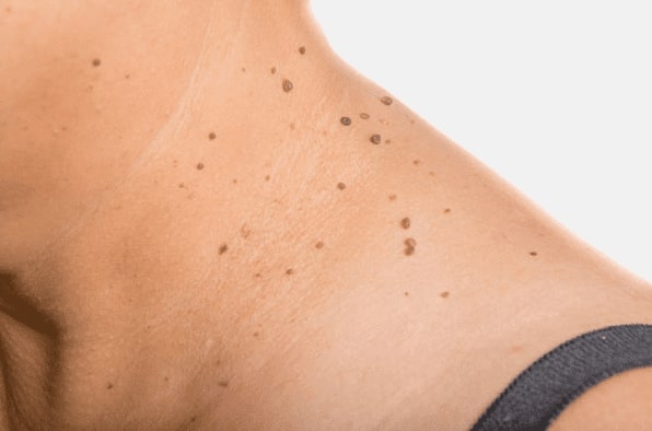 Are you looking for easy skin tag removal Allesley - then contact Spire today!
