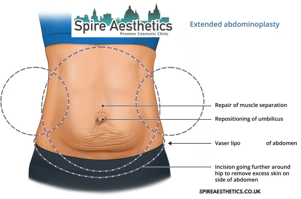Understanding Loose Skin After Gastric Band Allesley Surgery and HIFU Treatment
