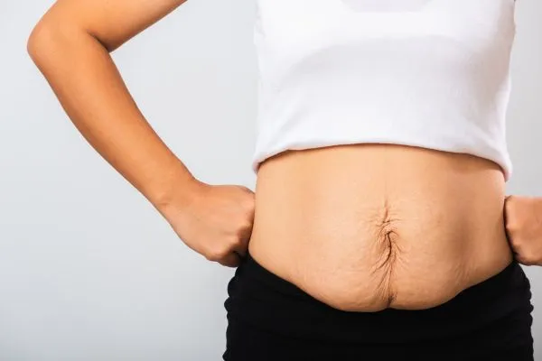 Image of a woman's stomach after weight loss with sagging skin following a gastric band Allesley