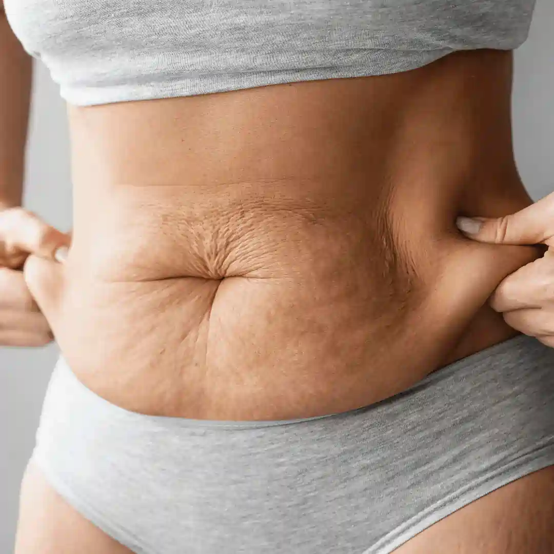 Is It Normal to Have Loose Skin After Pregnancy Allesley?